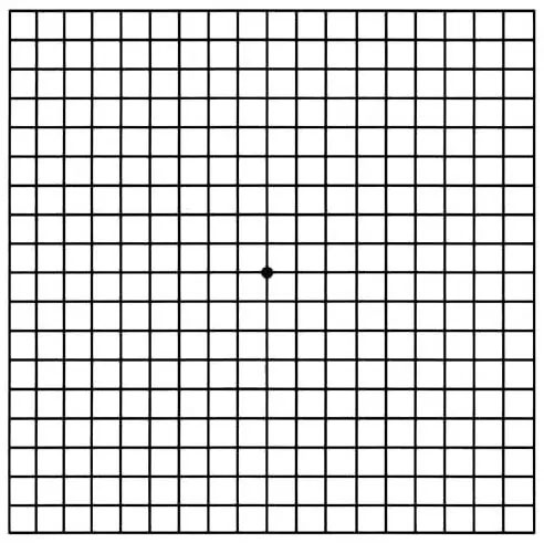 Retina and Uveitis Center | Diabetic Macular Edema DME , Micropulse Laser and Macular Hole