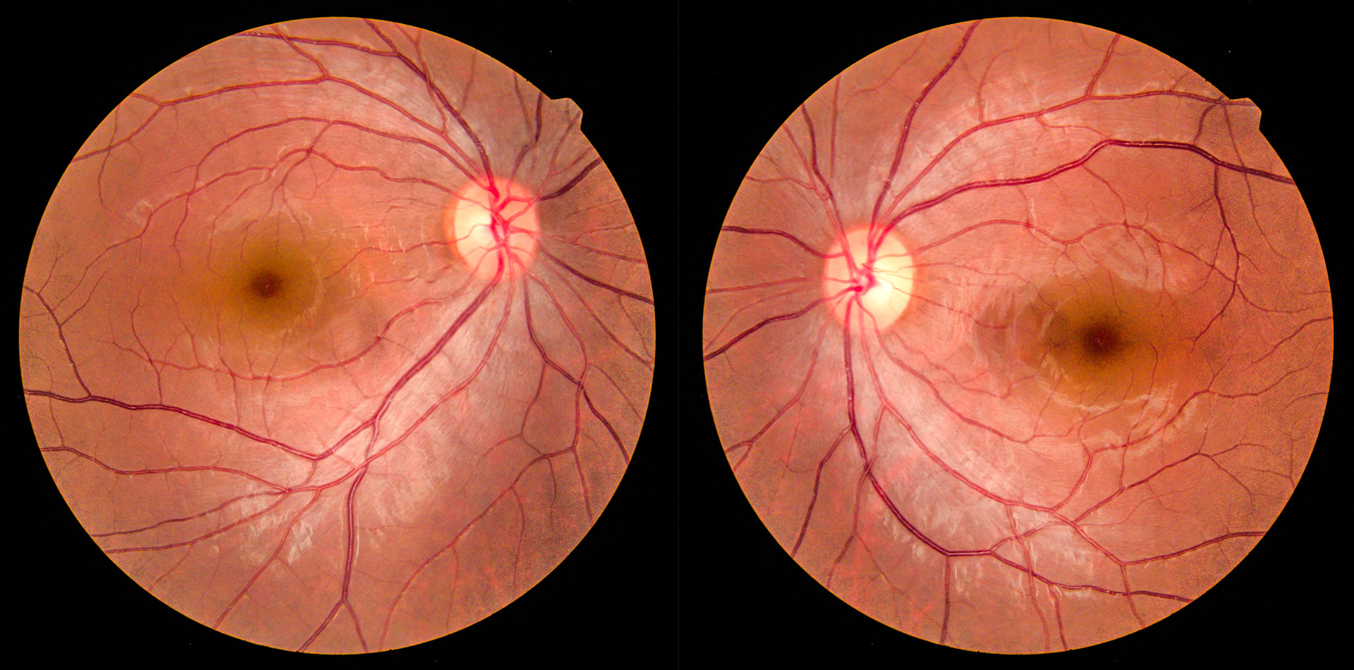 Retina and Uveitis Center | Artificial Iris, Choroidal Nevus and Cryotherapy