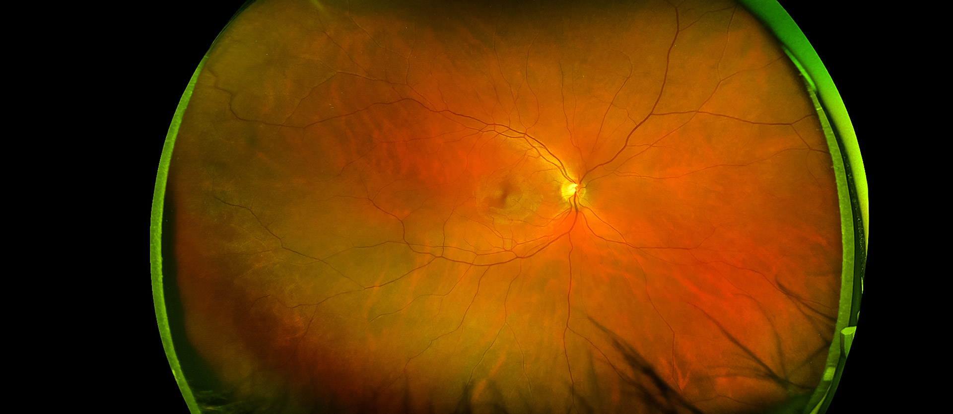 Retina and Uveitis Center | Artificial Iris, Choroidal Nevus and Cryotherapy