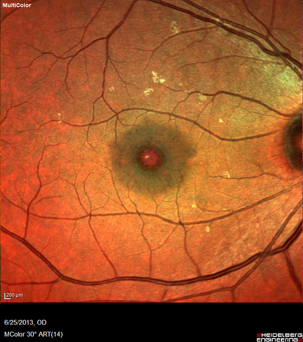 Retina and Uveitis Center | Uveitis, Retinal Detachment and Lattice Degeneration