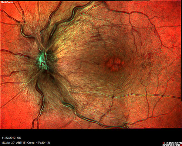 Retina and Uveitis Center | Toxoplasmosis, Micropulse Laser and Uveitis