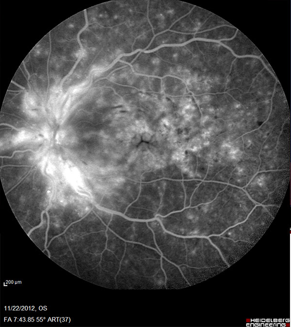 Retina and Uveitis Center | Diabetic Retinopathy  DR , Micropulse Laser and Retinal Artery Occlusion  RAO 