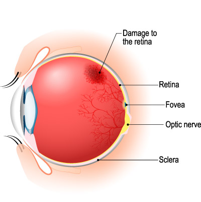 Retina and Uveitis Center | Rare Retinal Conditions, Retinal Detachment Repair and Vitrectomy