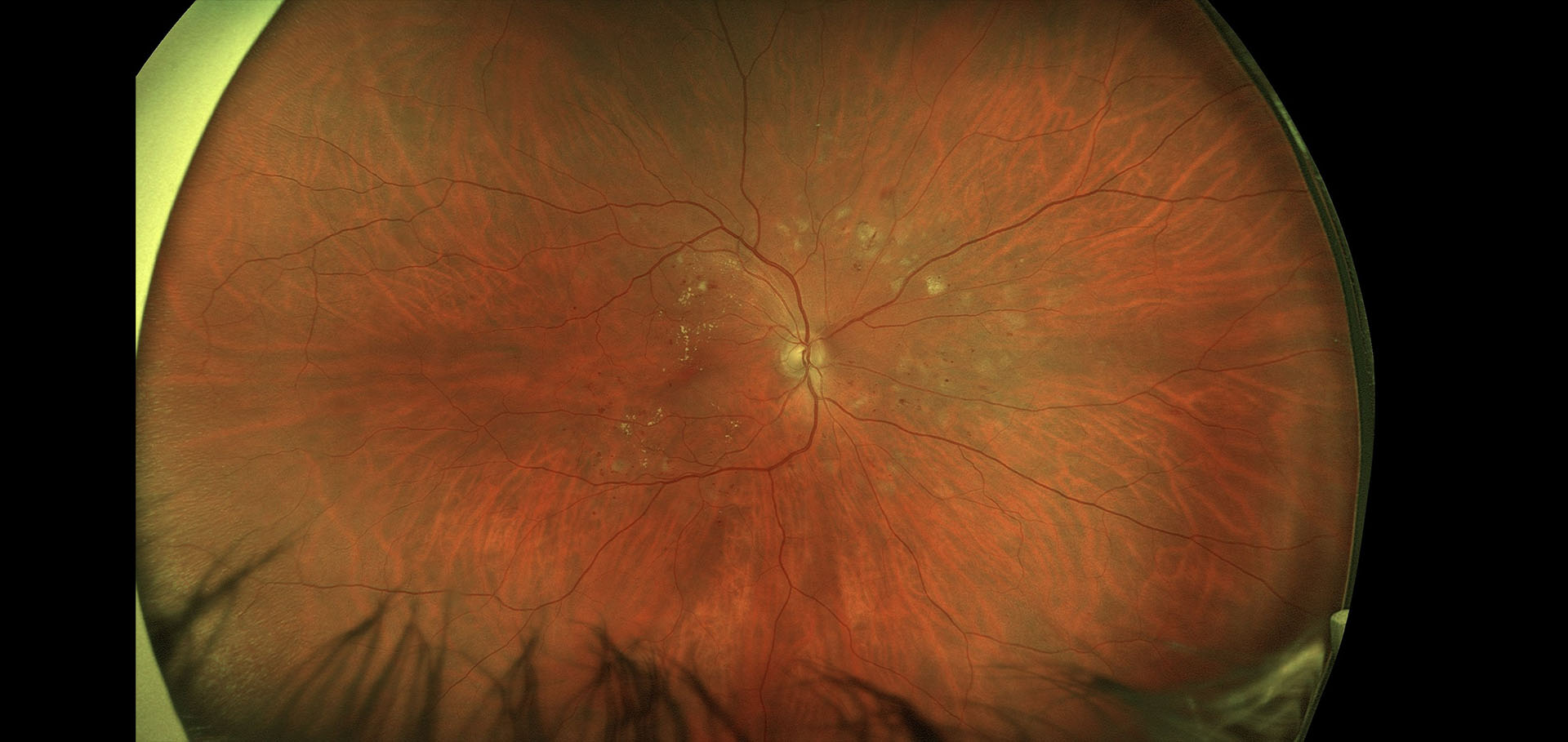 Retina and Uveitis Center | Pattern Dystrophy, Vitreomacular Traction and Lens Fragments