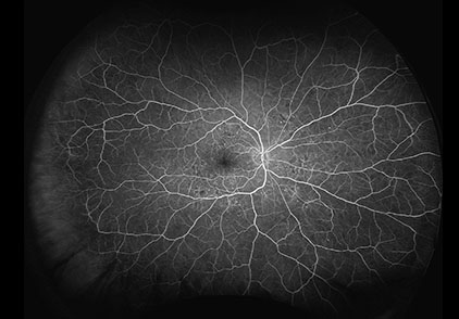 Retina and Uveitis Center | Retinal Detachment, Choroidal Melanoma and Retinal Detachment Repair