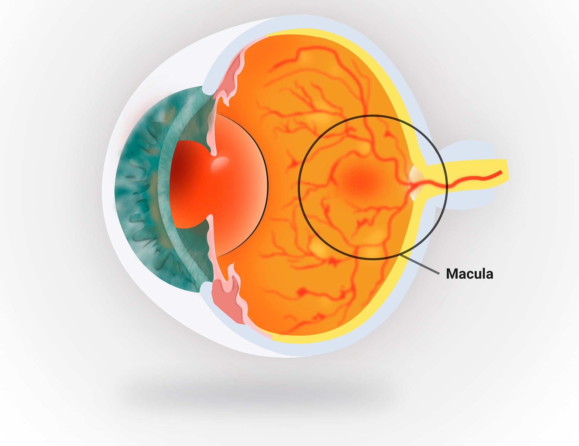 Retina and Uveitis Center | Vitrectomy, Retinal Tear and Sarcoidosis