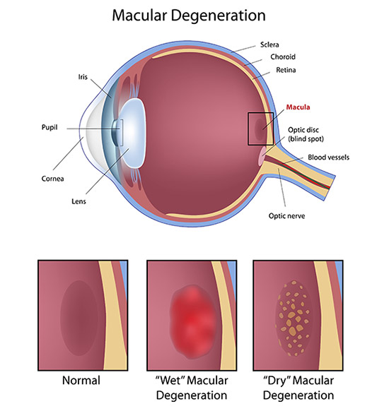 Retina and Uveitis Center | Floaters, Diabetic Tractional Retinal Detachment and Macular Pucker