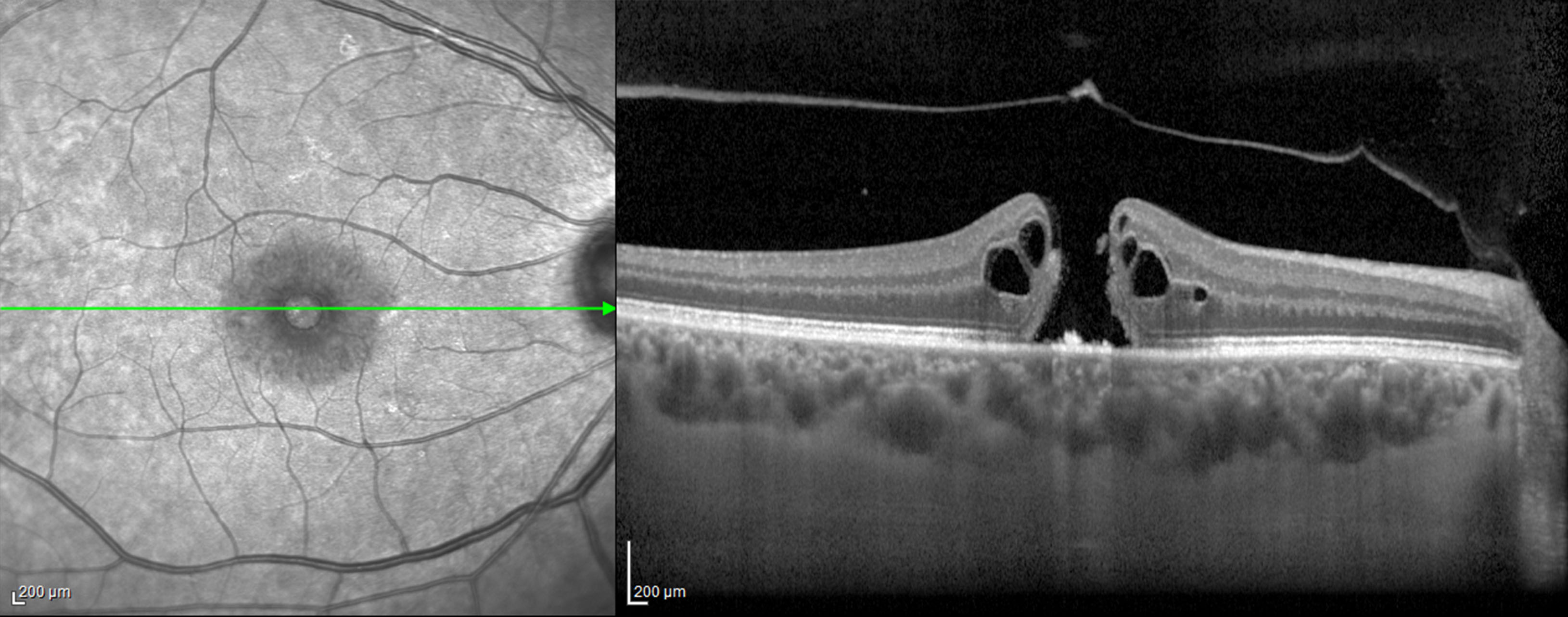 macular-hole-in-mclean-washington-d-c-macular-hole-treatment