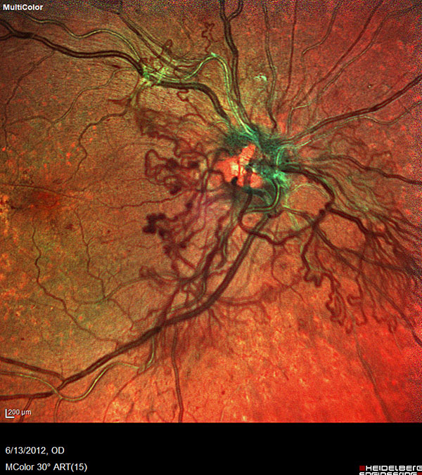 Retina and Uveitis Center | Posterior Vitreous Detachment  PVD , Central Serous Chorioretinopathy  CSC  and Retinal Artery Occlusion  RAO 