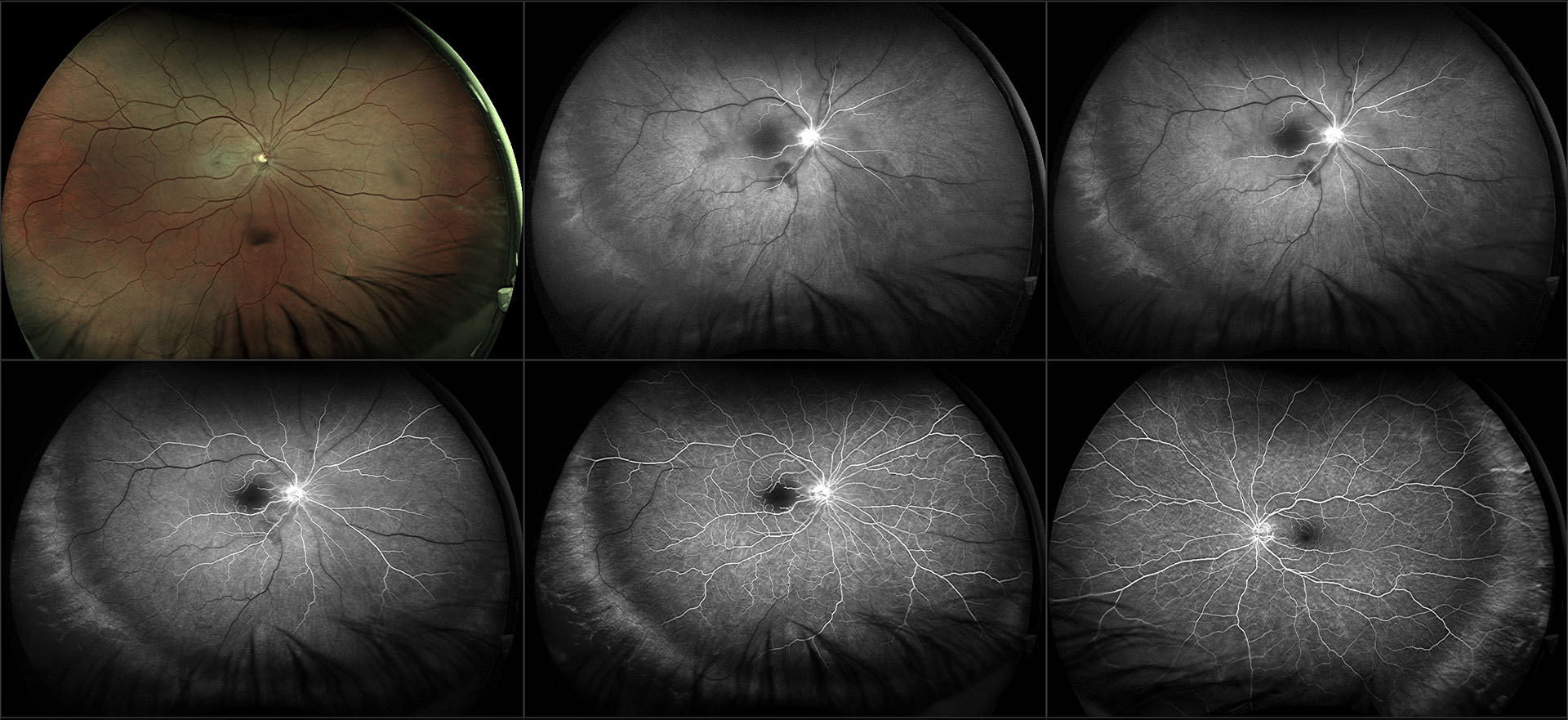 Retina and Uveitis Center