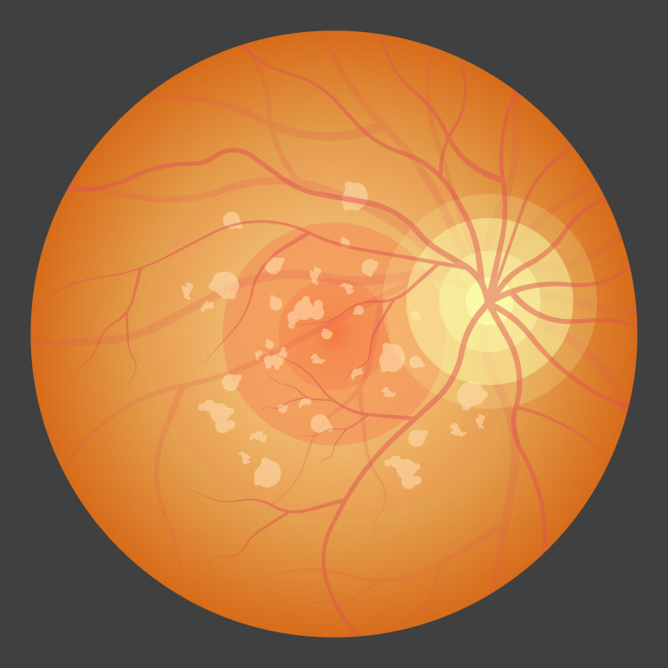 Retina and Uveitis Center | Retinal Artery Occlusion, Pattern Dystrophy and Dislocated IOL