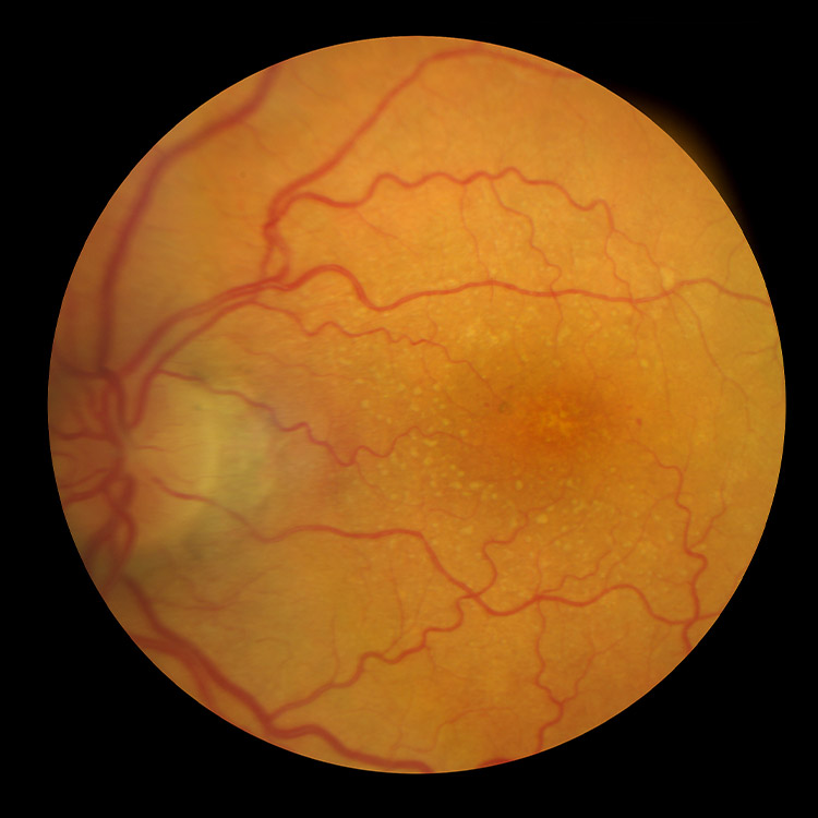 Retina and Uveitis Center | Macular Hole Surgery, Pattern Dystrophy and Macular Edema